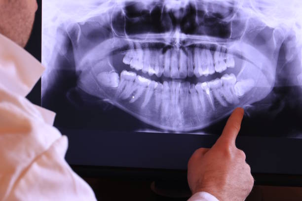 Best Emergency Wisdom Tooth Extraction in Milton, DE